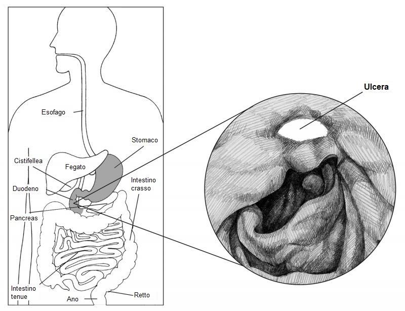 H. pylori può causare ulcerazioni nella parete dello stomaco e del duodeno. Fonte immagine: National Institute of Diabetes and Digestive and Kidney Diseases