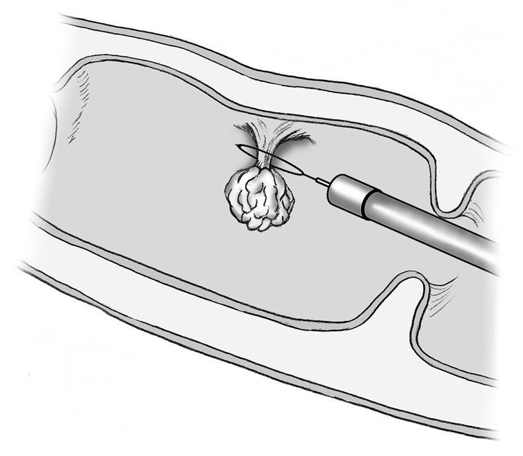 Rimozione di un polipo del colon. Fonte immagine: NIDDK