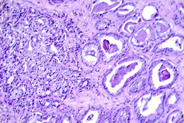 Vetrino istologico (biopsia) di un carcinoma prostatico. Fonte immagine: Otis Brawley, NCI