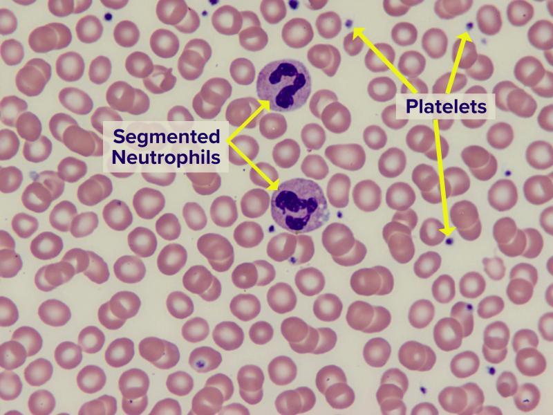 Striscio di sangue periferico normale; sono visibili i globuli rossi, due granulociti neutrofili (segmented neutrophils) e le piastrine (platelets). Fonte immagine: Bette Jamieson, MEd