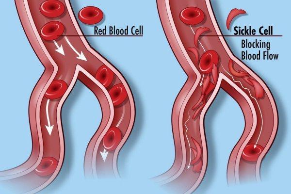 A sinistra globuli rossi normali. A destra globuli rossi falciformi che causano vaso occlusione. Fonte immagine: Darryl Leja, NHGRI