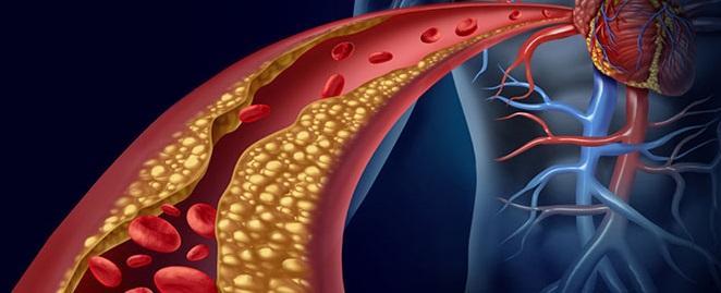 Il colesterolo in eccesso nel sangue può depositarsi sulle pareti dei vasi e formare placche, aumentando il rischio di infarto o ictus.